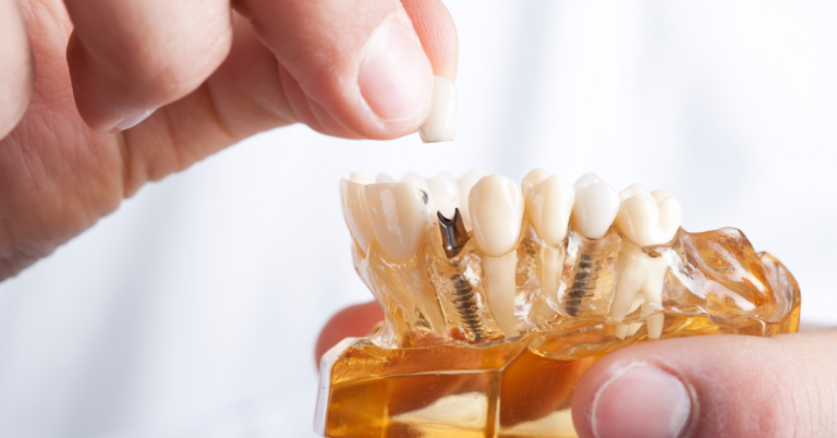 Can I Get Dental Implants If I Have A Chronic Medical Condition Like Diabetes Or Hypertension?