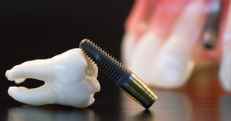 Can I Get Dental Implants If I Have Significant Bone Loss In My Jaw?