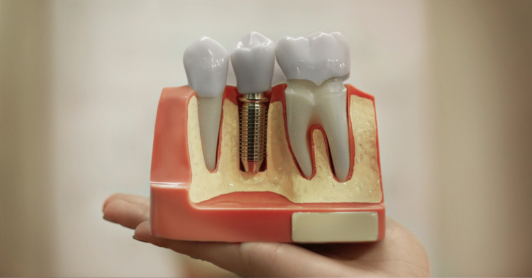 How Do I Clean And Care For Dental Implants On A Daily Basis?