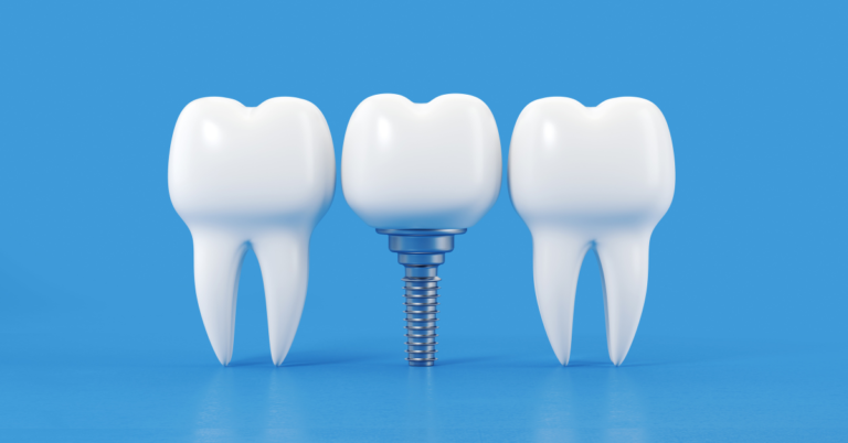 Can I get dental implants if I have a history of gum recession?
